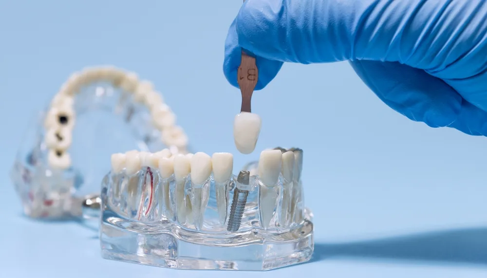 Dental Implant Maintenance for a Healthy Smile