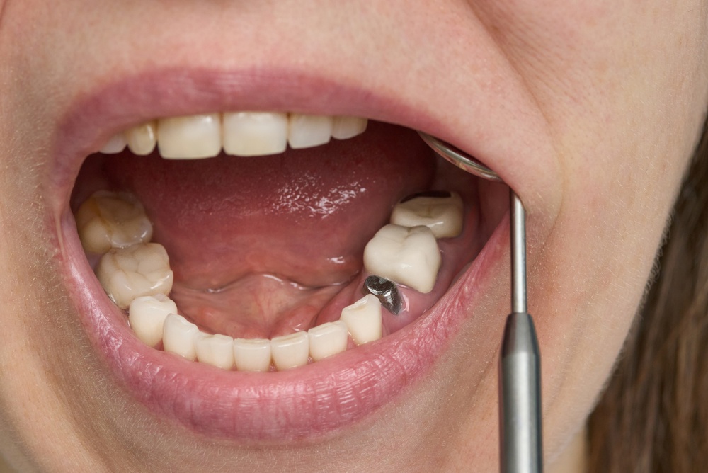How Long Does a Dental Implant Procedure Take?
