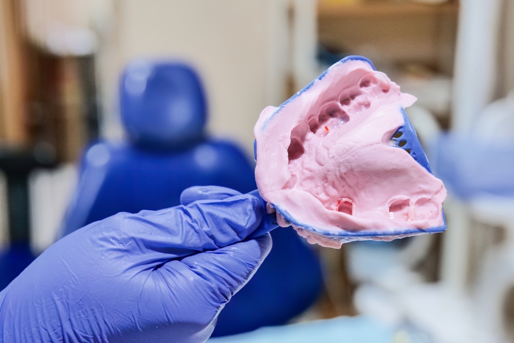 What Are Dental Impressions & How Long Do They Take?