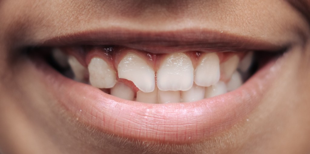 boy smiling broken teeth front
